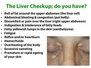 The Liver Checkup; do you have?
•   Roll of fat around the upper abdomen (the liver roll)
•   Abdominal bloating & congestion (pot belly)
•   Discomfort or pain over the liver (right upper abdomen)
•   Indigestion & intolerance of fatty foods
•   Fatty yellowish lumps in the skin (xanthelasma)
•   Fatigue
•   Reflux and/or heartburn
•   Hemorrhoids
•   Overheating of the body
•   Excessive sweating
•   Premature or rapid ageing
    of your skin
 