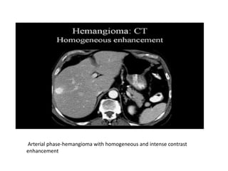 Arterial phase-hemangioma with homogeneous and intense contrast
enhancement
 