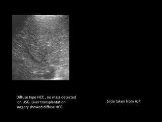 Liver imaging snapshots role of CT USG MRI in liver imaging. | PPT