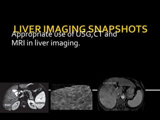 Appropriate use of USG,CT and
MRI in liver imaging.
 