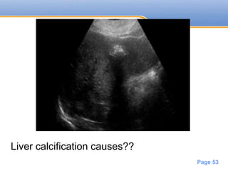 Powerpoint Templates
Page 53
Liver calcification causes??
 