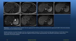Dr. Naveed AshrafRadiologic Pictorial Review
Metastases. In- (A) and opposed-phase (B) GRE T1-WI, fat-suppressed FSE T2-WI (C), pre (D) and postcontrast fat-suppressed 3D-GRE T1-WI at the arterial (E),
portal venous (F) and interstitial (G) phases.
Multiple metastases are present throughout the liver, showing low signal intensity on T1-WI (A, B and D) and high signal intensity on T2-WI. Most of these
lesions show hypervascular characteristics, while one in segment VII (arrow, E) shows ring enhancement. Late washout is perceived, a feature that is
characteristic of carcinoid metastases
11
 