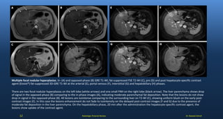 Dr. Naveed AshrafRadiologic Pictorial Review
Multiple focal nodular hyperplasias. In- (A) and opposed-phase (B) GRE T1-WI, fat-suppressed FSE T2-WI (C), pre (D) and post hepatocyte-specific contrast
agent (Eovist®) fat-suppressed 3D-GRE T1-WI at the arterial (E), portal venous (F), interstitial (G) and hepatobiliary (H) phases.
There are two focal nodular hyperplasias on the left lobe (white arrows) and one small FNH on the right lobe (black arrow). The liver parenchyma shows drop
of signal in the opposed-phase (B) comparing to the in-phase images (A), indicating moderate parenchymal fat deposition. Note that the lesions do not show
drop in signal in the opposed-phase (B). All lesions are isointense comparing to the surrounding liver on T2-WI (C), showing uniform blush on the early post-
contrast images (E). In this case the lesions enhancement do not fade to isointensity on the delayed post-contrast images (F and G) due to the presence of
moderate fat deposition in the liver parenchyma. On the hepatobiliary phase, 20 min after the administration the hepatocyte-specific contrast agent, the
lesions show uptake of the contrast agent.
12
 