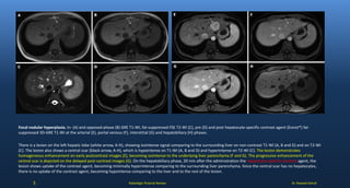 Dr. Naveed AshrafRadiologic Pictorial Review
Focal nodular hyperplasia. In- (A) and opposed-phase (B) GRE T1-WI, fat-suppressed FSE T2-WI (C), pre (D) and post hepatocyte-specific contrast agent (Eovist®) fat-
suppressed 3D-GRE T1-WI at the arterial (E), portal venous (F), interstitial (G) and hepatobiliary (H) phases.
There is a lesion on the left hepatic lobe (white arrow, A-H), showing isointense signal comparing to the surrounding liver on non-contrast T1-WI (A, B and D) and on T2-WI
(C). The lesion also shows a central scar (black arrow, A-H), which is hypointense on T1-WI (A, B and D) and hyperintense on T2-WI (C). The lesion demonstrates
homogeneous enhancement on early postcontrast images (E), becoming isointense to the underlying liver parenchyma (F and G). The progressive enhancement of the
central scar is depicted on the delayed post-contrast images (G). On the hepatobiliary phase, 20 min after the administration the hepatocyte-specific contrast agent, the
lesion shows uptake of the contrast agent, becoming minimally hyperintense comparing to the surrounding liver parenchyma. Since the central scar has no hepatocytes,
there is no uptake of the contrast agent, becoming hypointense comparing to the liver and to the rest of the lesion.
5
 