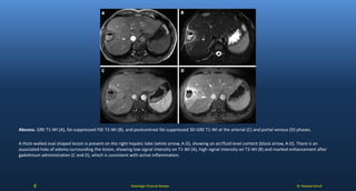Dr. Naveed AshrafRadiologic Pictorial Review
Abscess. GRE T1-WI (A), fat-suppressed FSE T2-WI (B), and postcontrast fat-suppressed 3D-GRE T1-WI at the arterial (C) and portal venous (D) phases.
A thick-walled oval shaped lesion is present on the right hepatic lobe (white arrow, A-D), showing an air/fluid level content (black arrow, A-D). There is an
associated halo of edema surrounding the lesion, showing low signal intensity on T1-WI (A), high signal intensity on T2-WI (B) and marked enhancement after
gadolinium administration (C and D), which is consistent with active inflammation.
8
 