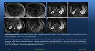 Dr. Naveed AshrafRadiologic Pictorial Review
Hepatocellular carcinoma. In- (A) and opposed-phase (B) GRE T1-WI, fat-suppressed FSE T2-WI (C), pre (D) and postcontrast fat-suppressed 3D-GRE T1-WI at
the arterial (E), portal venous (F) and interstitial (G) phases.
There is a small peripheral lesion on the right lobe of a cirrhotic liver (arrow, A-G), showing drop of signal intensity on opposed-phase (B) comparing with the
in-phase (A) images, which is suggestive of fat content. The lesion demonstrates mild high signal intensity on T2-WI (C), low signal intensity on pre-contrast
T1-WI (C), heterogeneous enhancement on early post-contrast (E) and subsequent washout with associated pseudocapsule on delayed post-contrast images
(F and G), in keeping with a small fat-containing hepatocellular carcinoma.
9
 