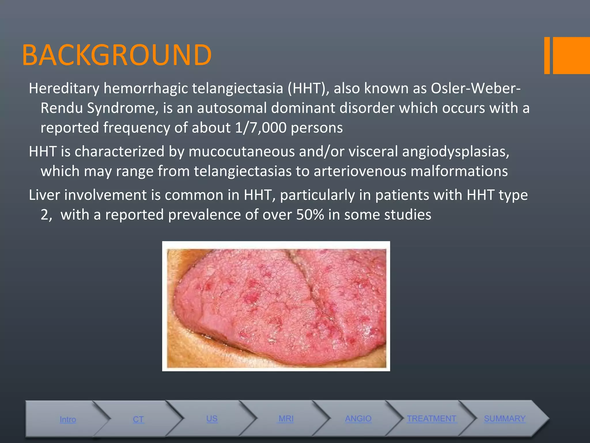 Liver manifestations of hht revised | PPT