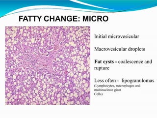 Initial microvesicular
Macrovesicular droplets
Fat cysts - coalescence and
rupture
Less often - lipogranulomas
(Lymphocytes, macrophages and
multinucleate giant
Cells)
FATTY CHANGE: MICRO
 