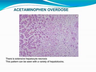 ACETAMINOPHEN OVERDOSE
There is extensive hepatocyte necrosis
This pattern can be seen with a variety of hepatotoxins.
 