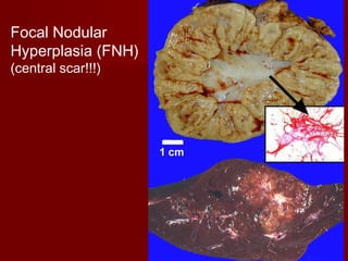 Focal Nodular
Hyperplasia (FNH)
(central scar!!!)
 