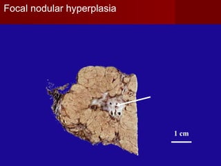 1 cm
Focal nodular hyperplasia
 