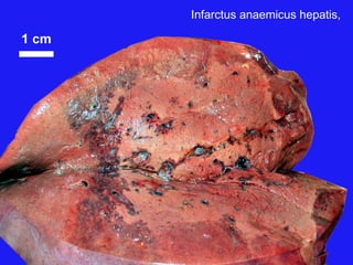 Infarctus anaemicus hepatis,
 