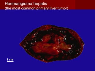 1 cm
Haemangioma hepatis
(the most common primary liver tumor)
 