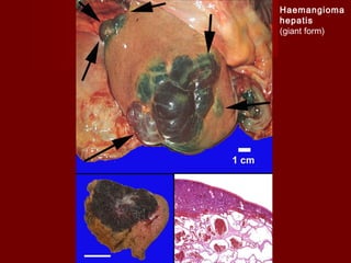 Haemangioma
hepatis
(giant form)
 