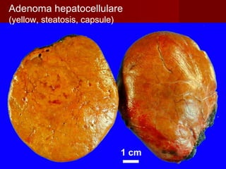 Adenoma hepatocellulare
(yellow, steatosis, capsule)
 