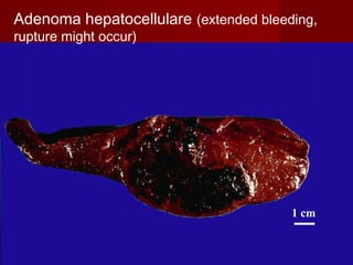 1 cm
Adenoma hepatocellulare (extended bleeding,
rupture might occur)
 