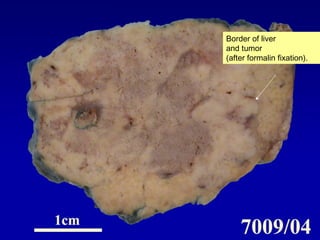Border of liver
and tumor
(after formalin fixation).
 