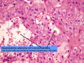 Hepatocellula adenoma with extended peliosis.
The tumor cells are similar to normal hepatocytes. HE stain
 