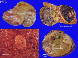 HCC
extracapsular
cirrhosis
HCC
necrosis
 