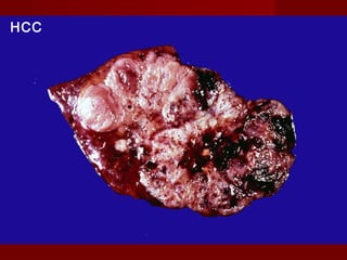 HCC
 