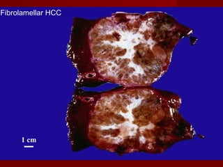 1 cm
Fibrolamellar HCC
 