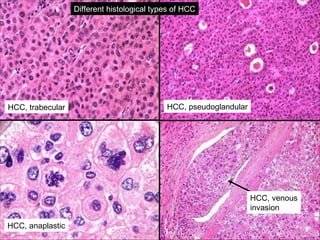 Different histological types of HCC
HCC, trabecular HCC, pseudoglandular
HCC, anaplastic
HCC, venous
invasion
 