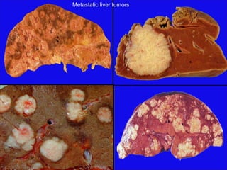 Metastatic liver tumors
 