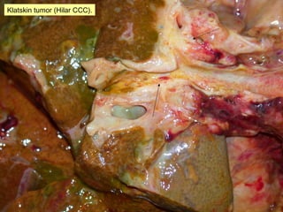 Klatskin tumor (Hilar CCC).
 