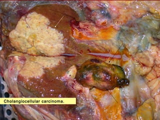 Cholangiocellular carcinoma.
 