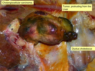 Cholangiocellular carcinoma.
Ductus choledocus
Tumor, protruding from the
Liver
 