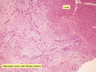 Liver
Glandular tumor with fibrotic stroma
 