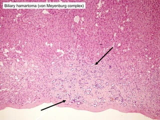 Biliary hamartoma (von Meyenburg complex)
 
