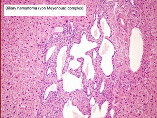 Biliary hamartoma (von Meyenburg complex)
 