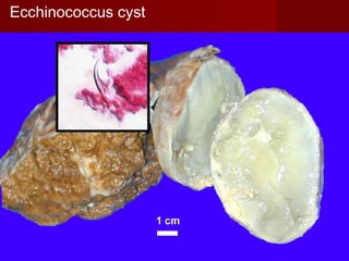 Ecchinococcus cyst
 