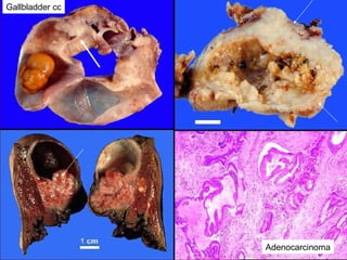 Gallbladder cc
Adenocarcinoma
 