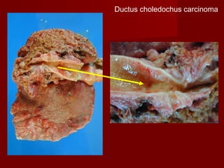 Ductus choledochus carcinoma
 