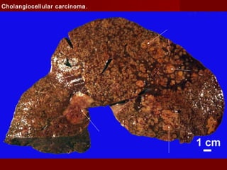 Cholangiocellular carcinoma.
 