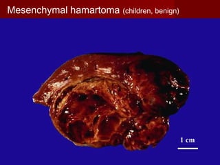 1 cm
Mesenchymal hamartoma (children, benign)
 