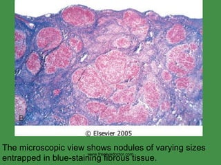 The microscopic view shows nodules of varying sizes entrapped in blue-staining fibrous tissue.   www.freelivedoctor.com 