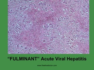 “ FULMINANT” Acute Viral Hepatitis www.freelivedoctor.com 