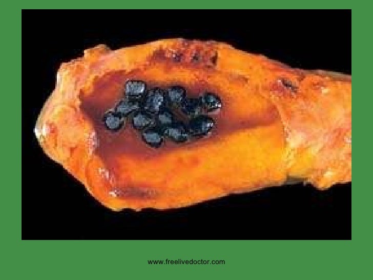 Liver pothology