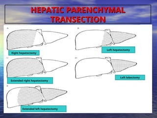 Transsection LIVER RESECTION TECHNICAL ADVANCES & COMPLICATIONS 2018.ppt