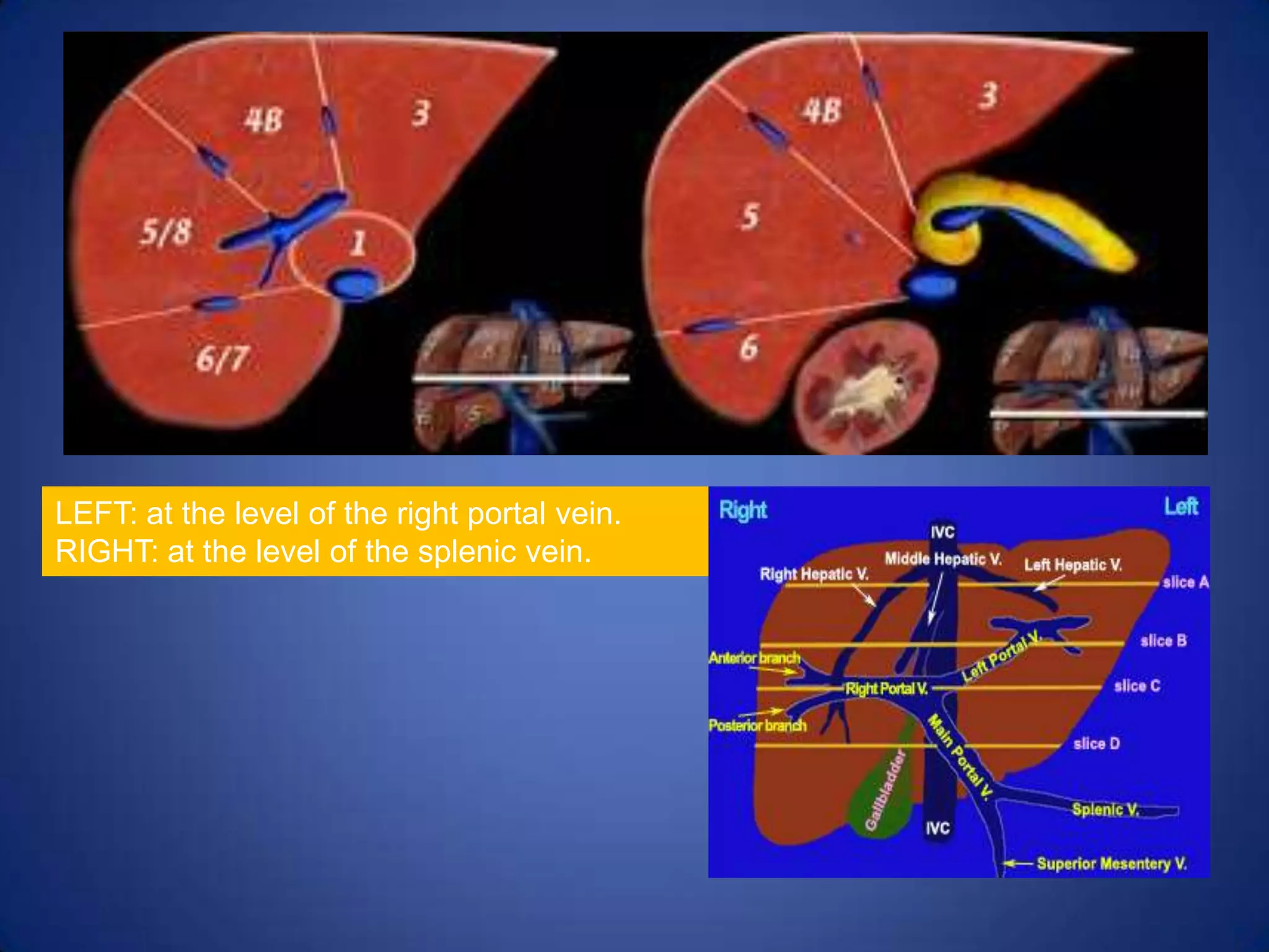 LEFT: at the level of the right portal vein.
RIGHT: at the level of the splenic vein.
 