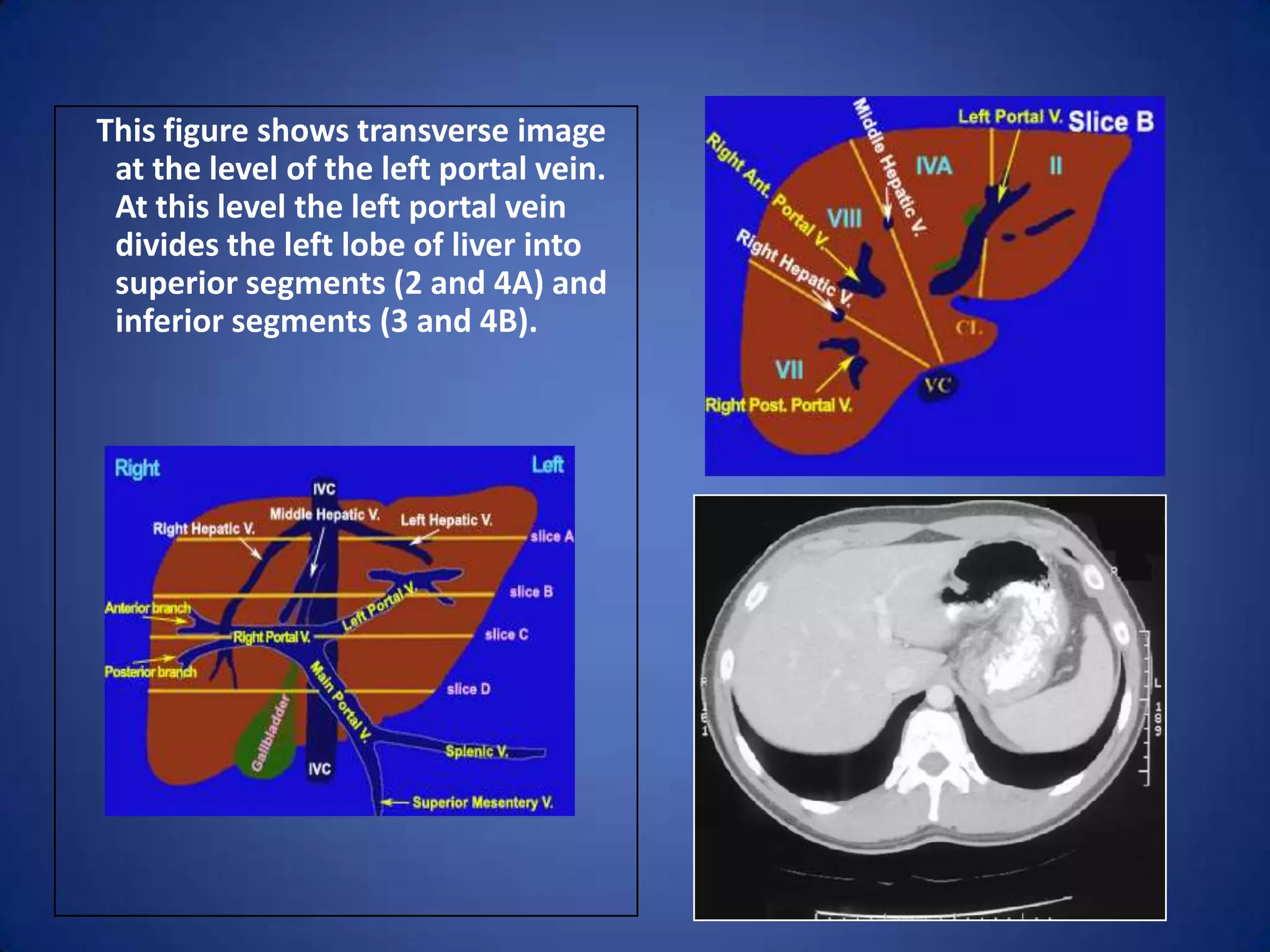 This figure shows transverse image
at the level of the left portal vein.
At this level the left portal vein
divides the left lobe of liver into
superior segments (2 and 4A) and
inferior segments (3 and 4B).
 