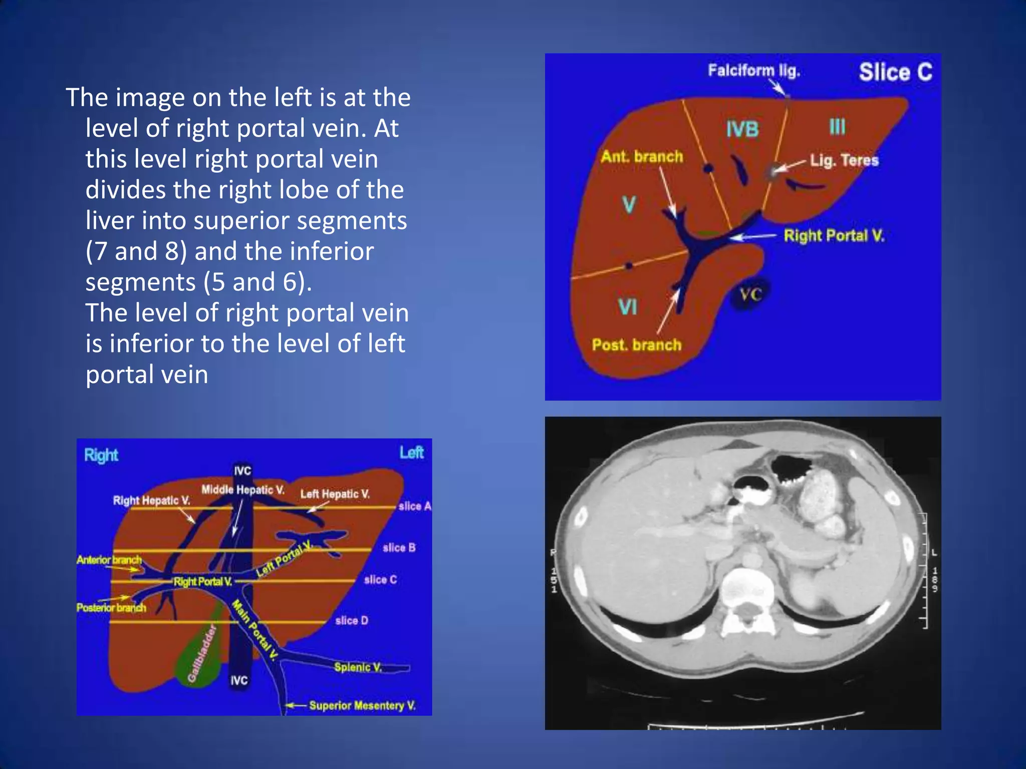 The image on the left is at the
level of right portal vein. At
this level right portal vein
divides the right lobe of the
liver into superior segments
(7 and 8) and the inferior
segments (5 and 6).
The level of right portal vein
is inferior to the level of left
portal vein
 
