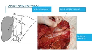RIGHT HEPATECTOMY
RIGHT HEPATIC FISSURE
Posterior
segments
anterior segments
 