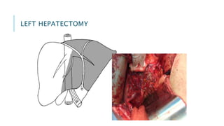 LEFT HEPATECTOMY
 