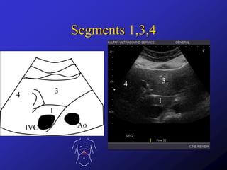 Liver segments on ultrasound | PPTX