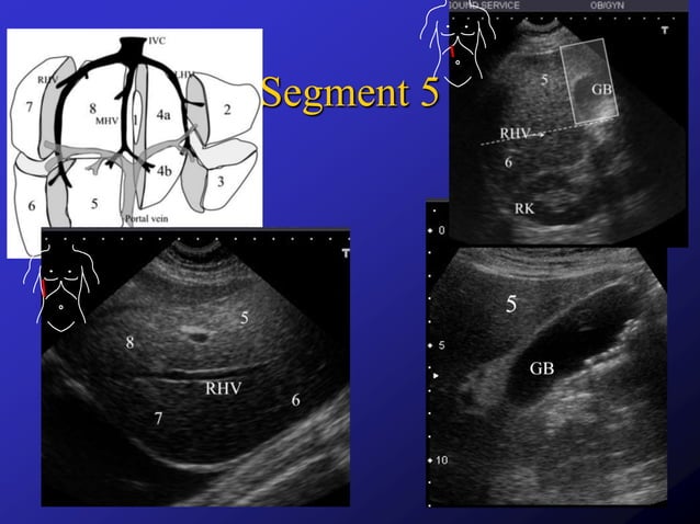 Liver segments on ultrasound | PPTX