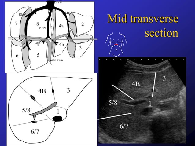 Liver segments on ultrasound | PPTX